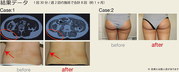 ラジオ波の結果データ
