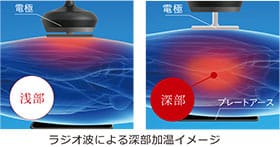 ラジオ波による深部加温イメージ